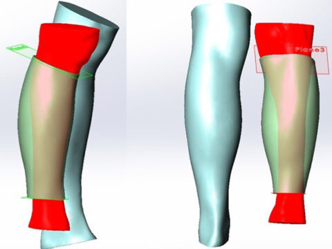 3D Scanning for Prosthesis