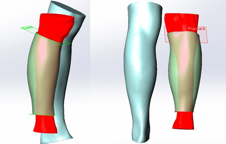 3D Scanning for Prosthesis
